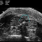 thyroid-tumor-1.jpg