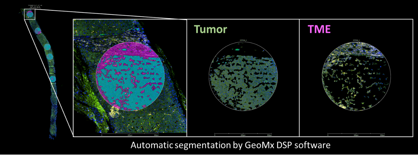 Oncology Lausanne ILL segmentation using GeoMX DSP.png